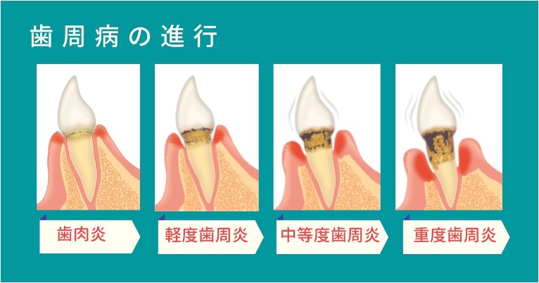 歯周病とはどんな病気? 歯肉炎との違いや症状について新伊丹駅の歯科医が解説|伊丹とく歯科|伊丹市で“丁寧すぎる”歯科治療。精密な技術と審美の追求