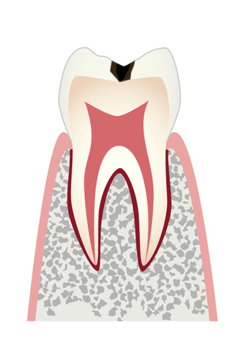 ムシ歯C1
