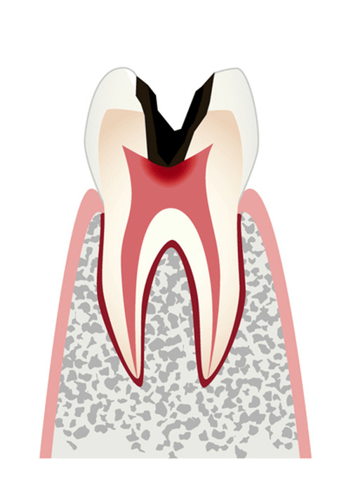 ムシ歯C3