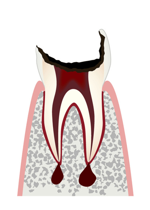 ムシ歯C4